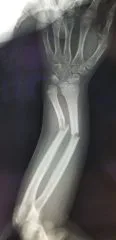子供の骨折 前腕 三木整形外科クリニック