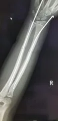 子供の骨折 前腕 三木整形外科クリニック